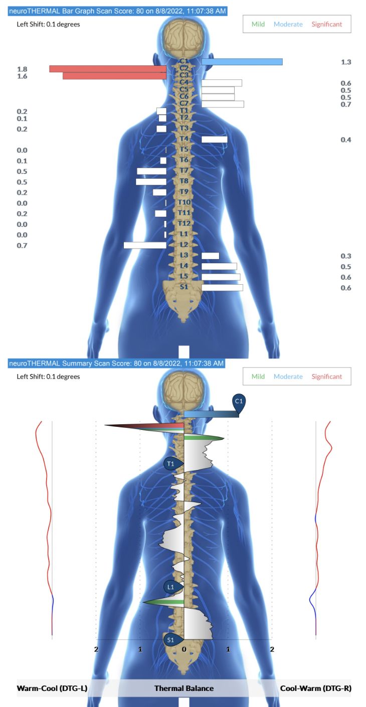 Neurothermal INSiGHT Scan Neurothermal INSiGHT scan showing nervous system stress patterns